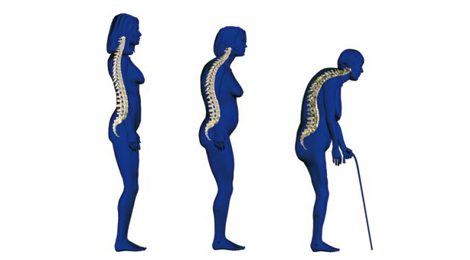 Grotere bewustwording osteoporose noodzakelijk