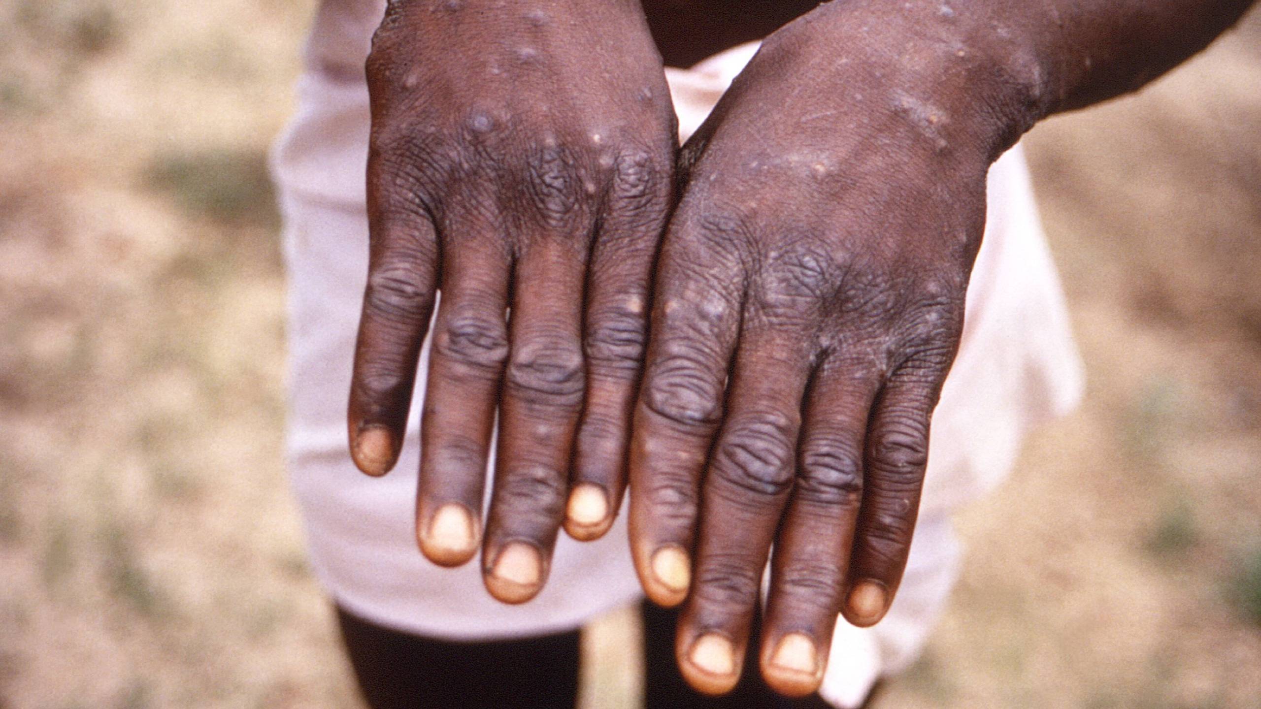 Sanità pubblica: nessuna segnalazione di vaiolo delle scimmie in Suriname