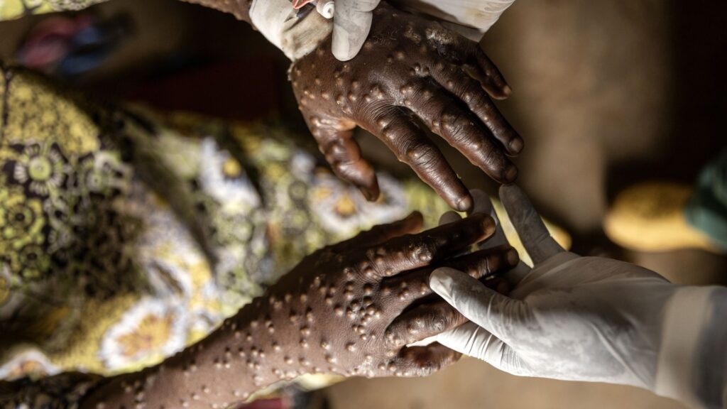 Afrika lanceert continentaal plan om snelle verspreiding van mpox te bestrijden